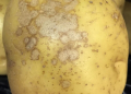 Potato diseases