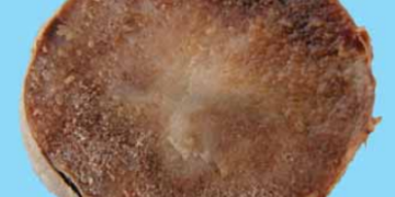 Late Blight Symptoms on Tubers