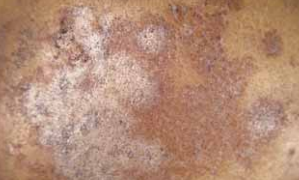 Silver Scurf (Helminthosporium solani)