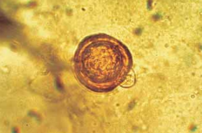 Zaraza ziemniaka (Phytophthora infestans) 3 zaraza1